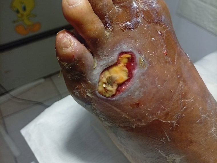 Úlcera de pie diabético tratada en Clínica Familiar Eliette, Apopa